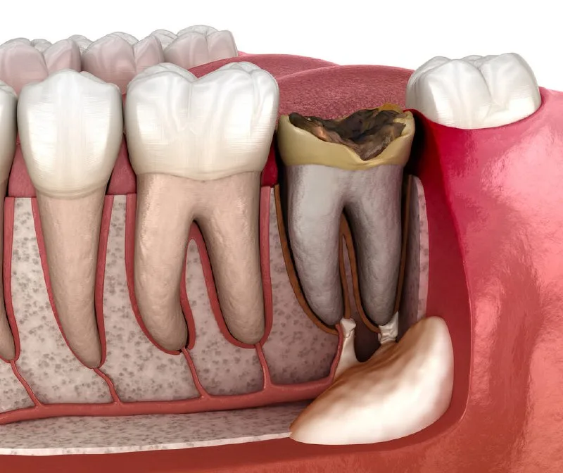 caries en cuello