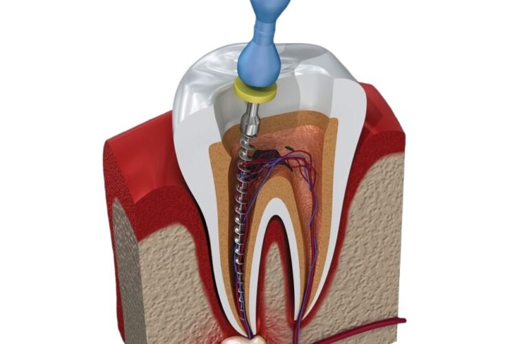 Endodoncia