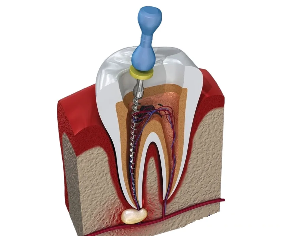 Endodoncia