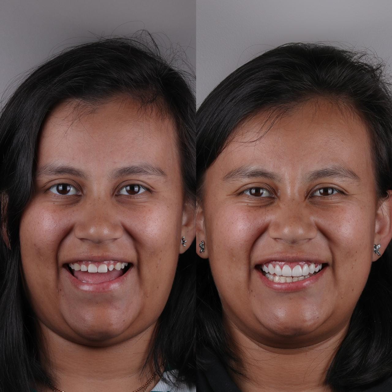 Antes y después de un caso de diseño de sonrisa