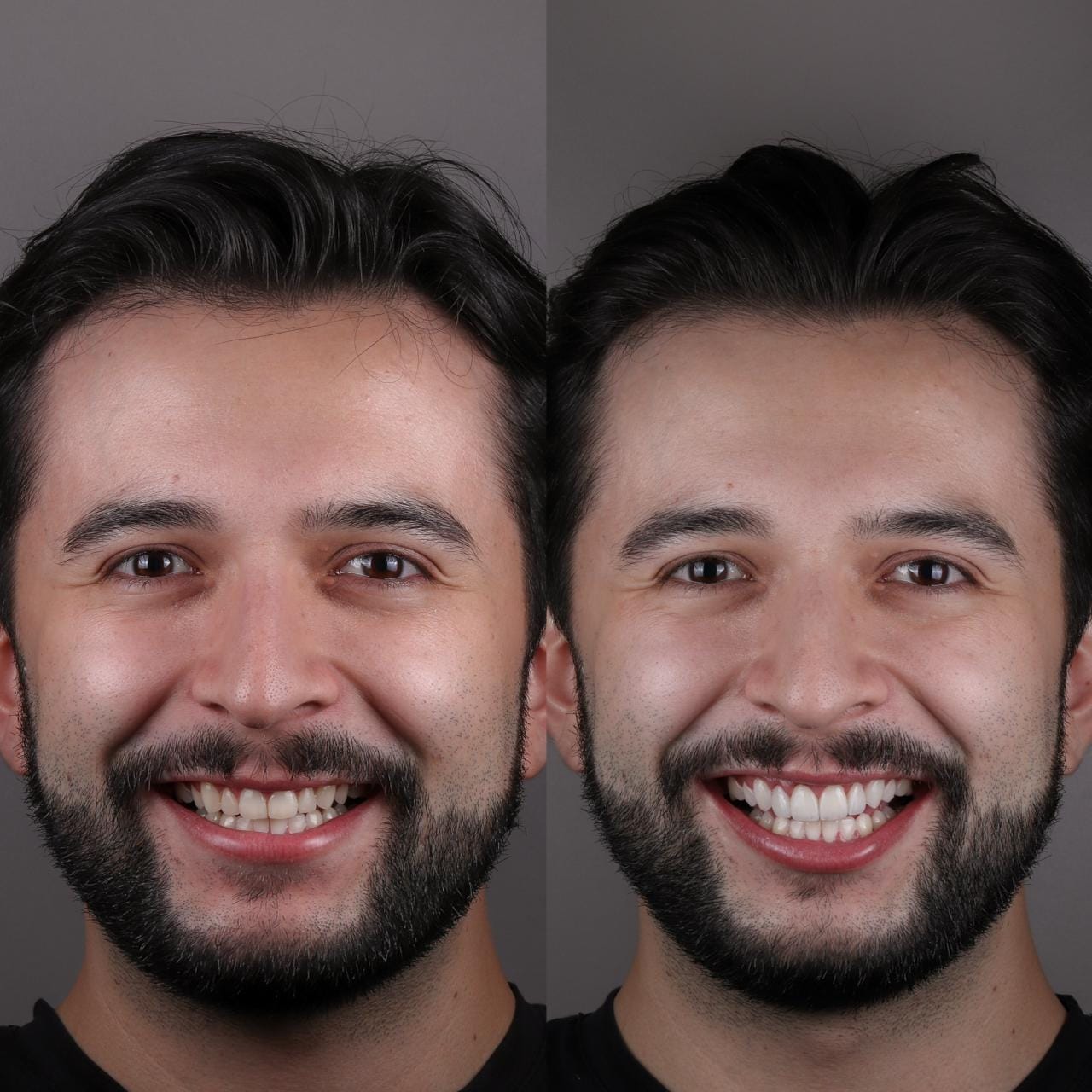 Antes y después de un caso de diseño de sonrisa