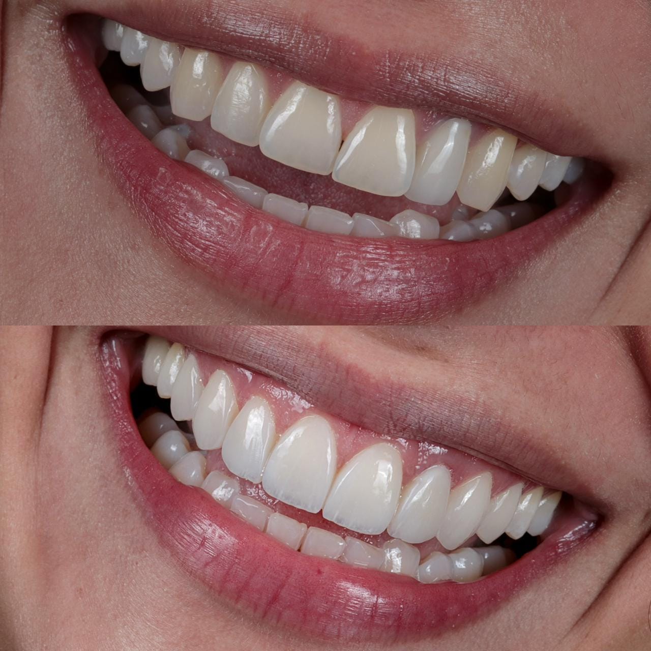 Antes y después de un caso de diseño de sonrisa