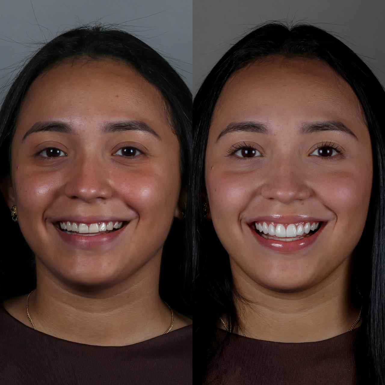 Antes y después de un caso real de diseño de sonrisa