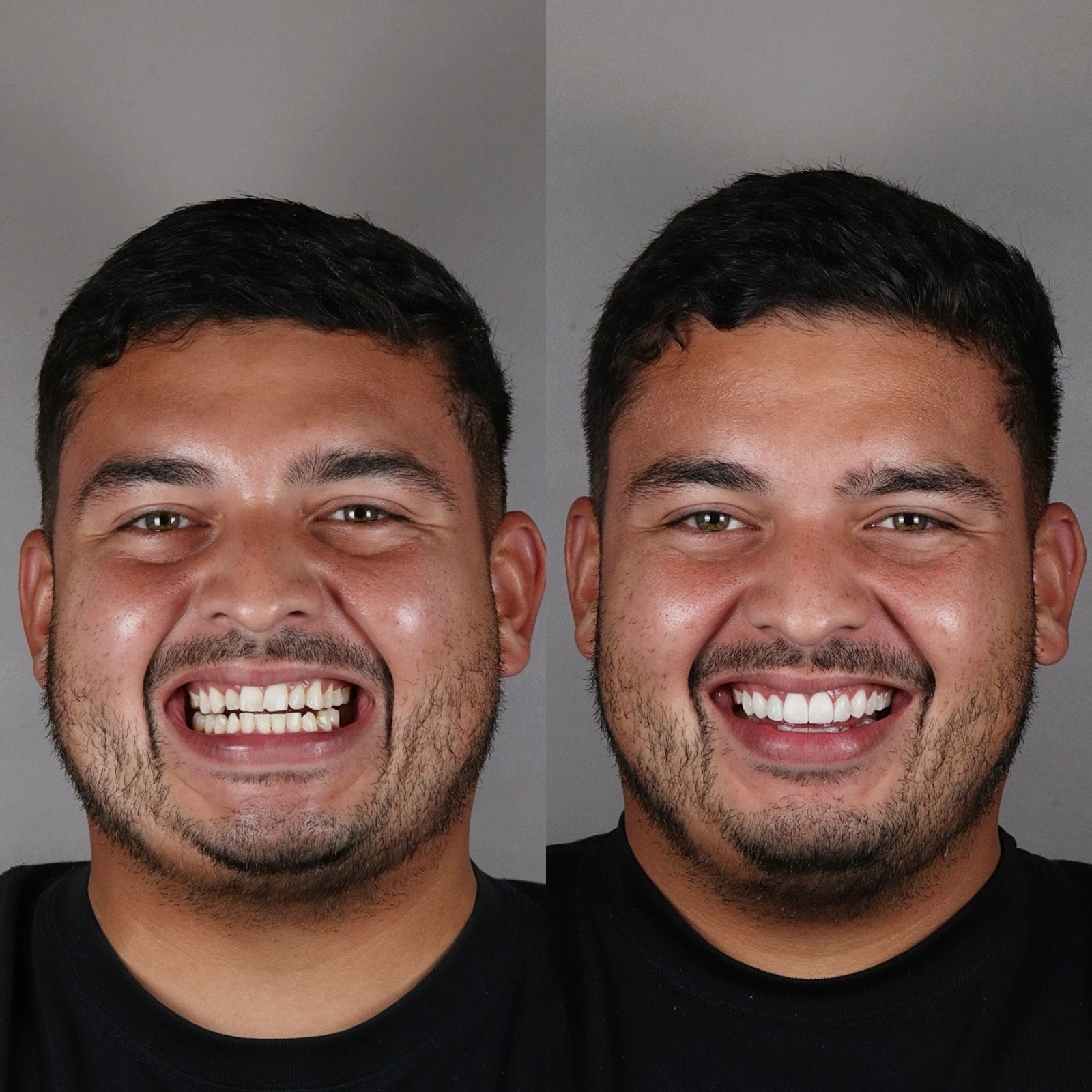 Antes y después de un caso de diseño de sonrisa