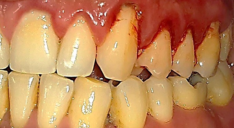 Imágenes de Tratamientos - Periodoncia e Implantes dentales Dra Johanna ...