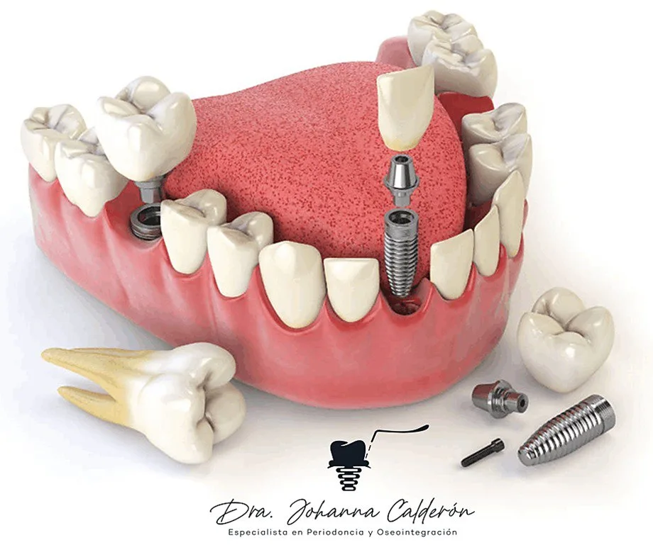 Dental implants in 24 hours | Dental Tourism Colombia | Implantes estrategicos Colombia Dra Johanna Calderón en Bocagrande