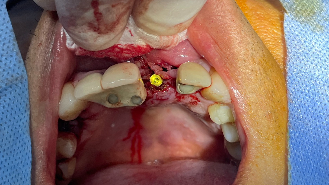 Implantes dentales