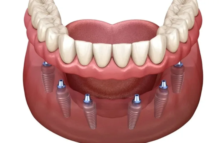 Implantes dentales all on 4