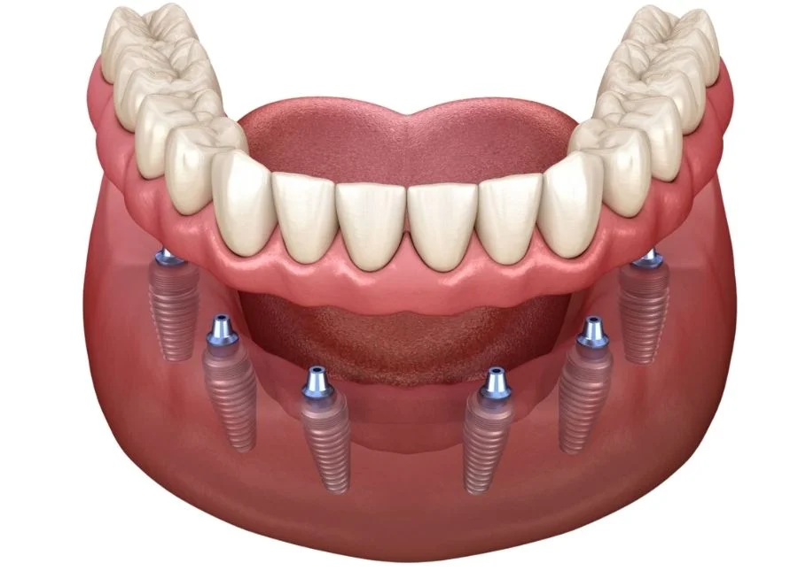 Implantes dentales all on 4