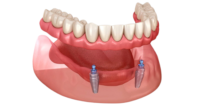 Sobredentadura sobre implantes