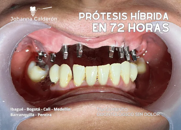 Fixed prosthesis on implants