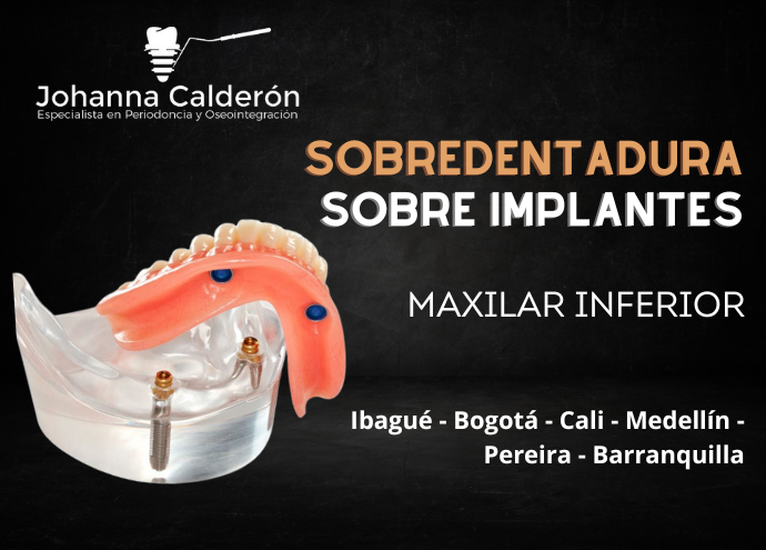 Sobredentadura sobre 2 implantes