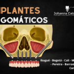 Implantes cigomaticos