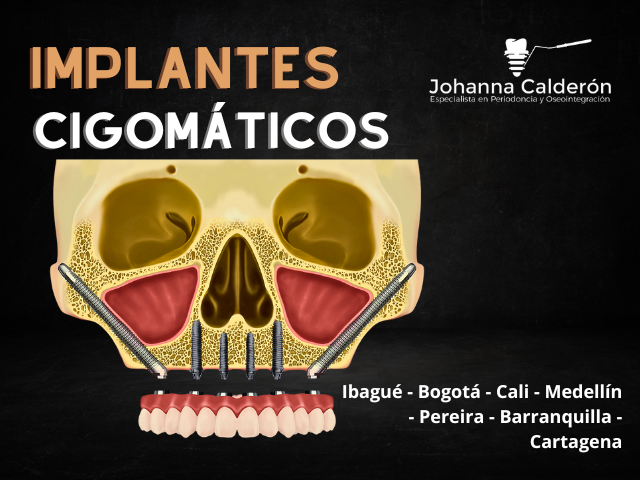 Implantes cigomaticos