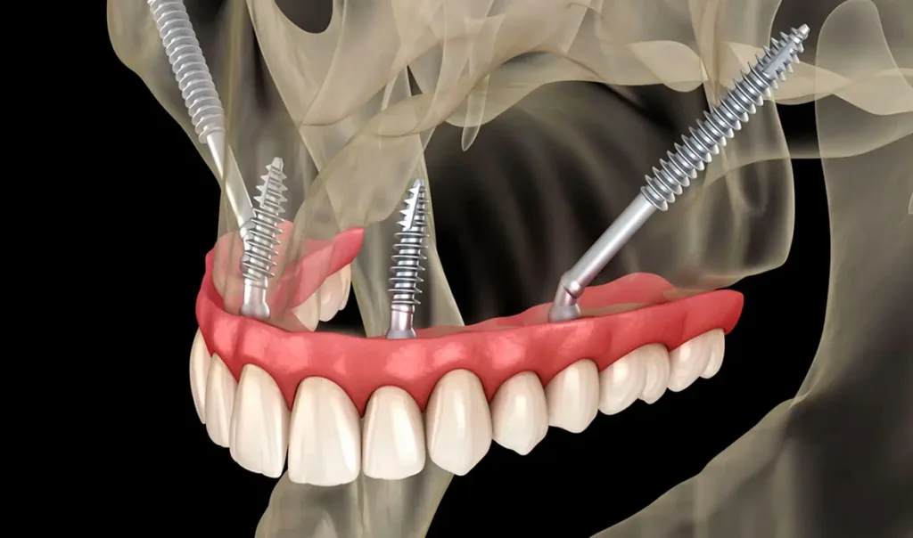 Implantes cigomaticos