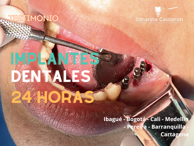 Implantes estrategicos en 24 horas