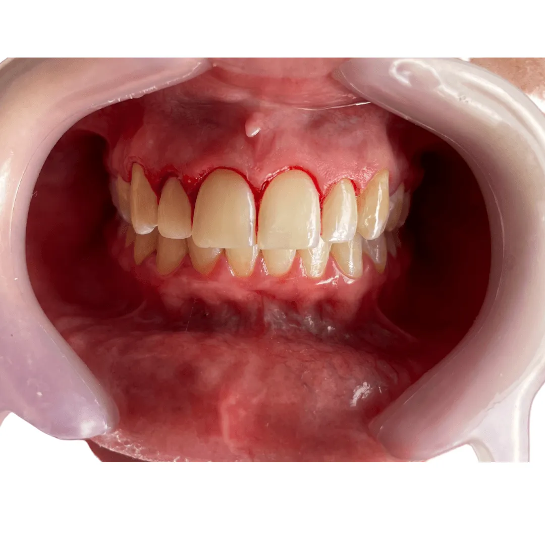 Gingivectomia