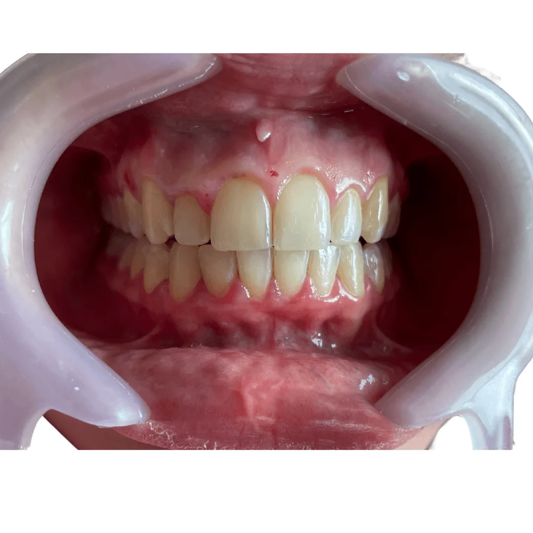 Gingivectomia