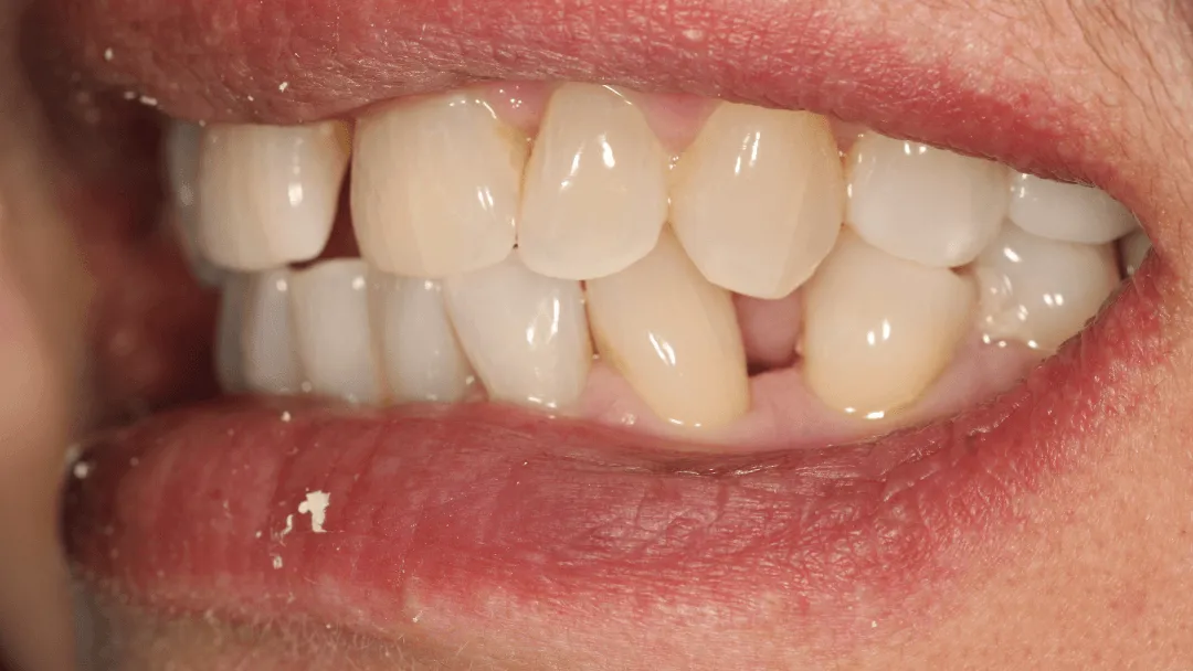 Coronas sobre implantes dentales