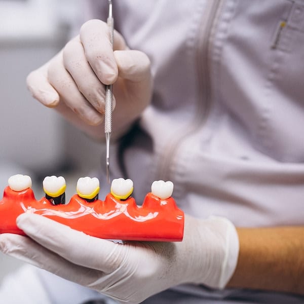 what-are-dental-crowns-and-when-do-you-need-one