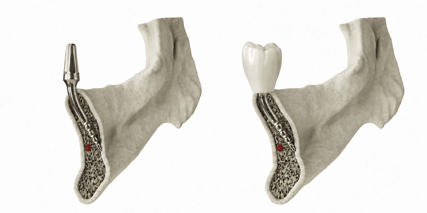 Strategic single-phase dental implant anchored in the cortical bone