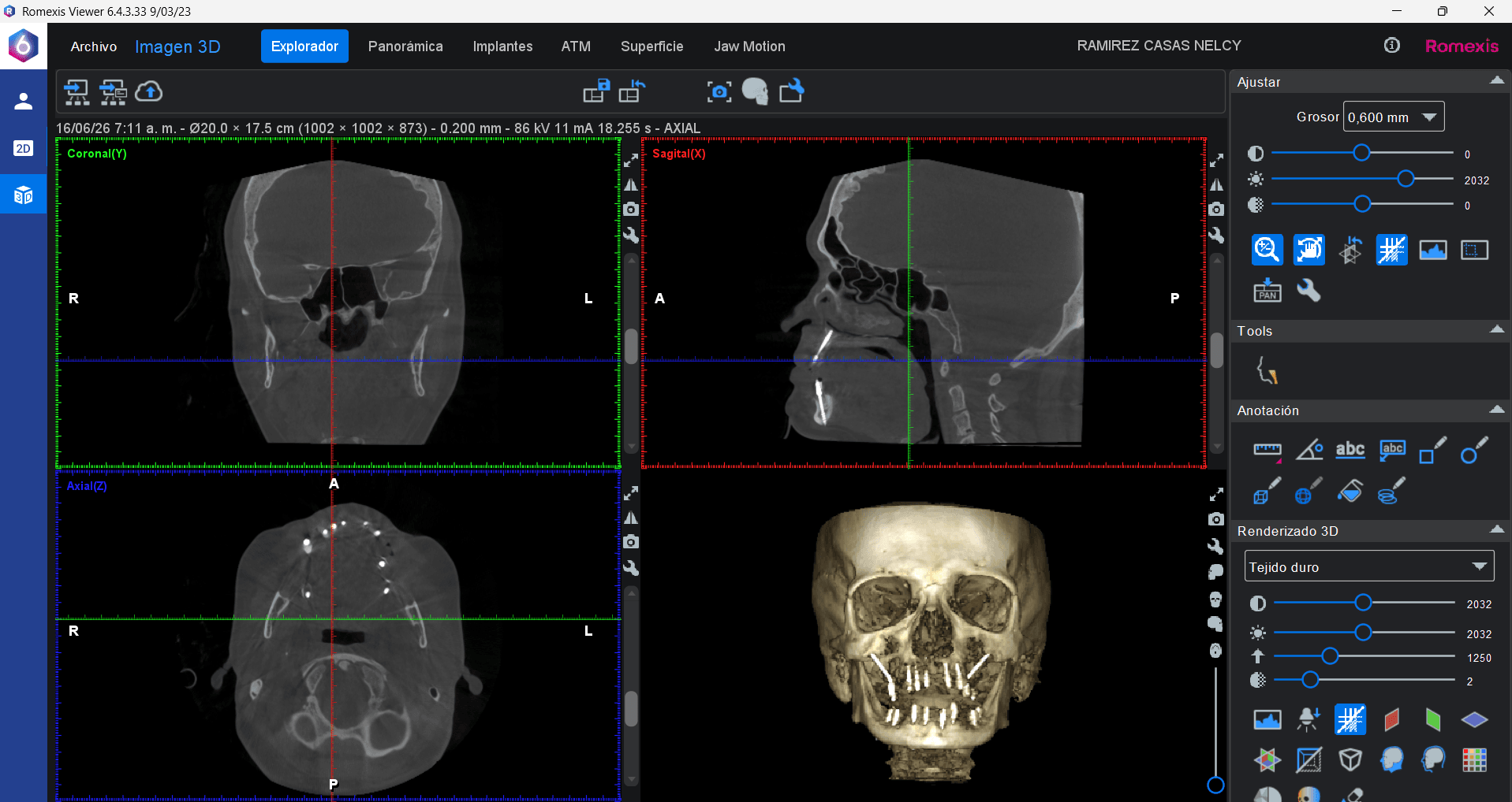 CT scan for planning strategic implants in Colombia