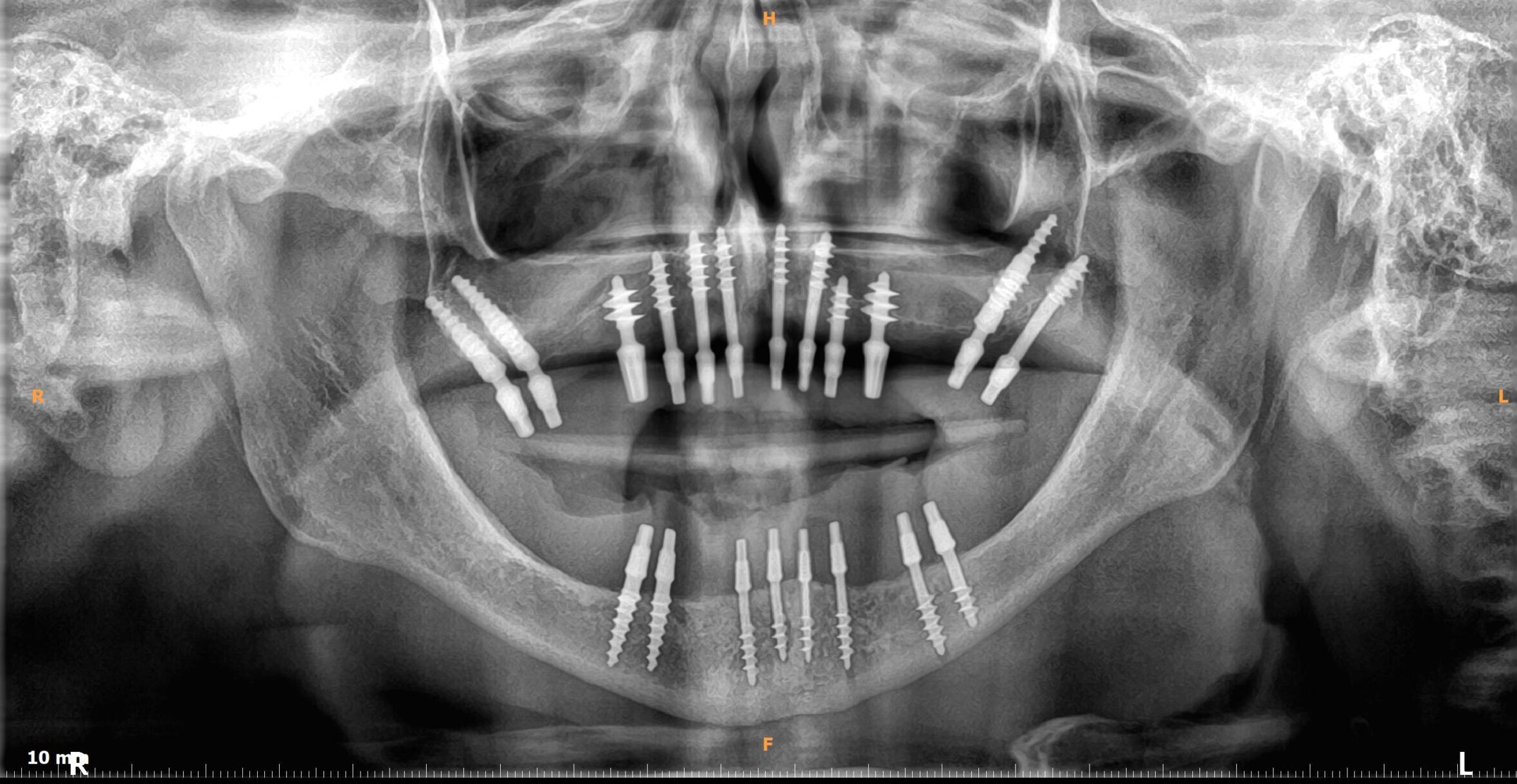 Radiografía panorámica para la planificación de implantes estratégicos