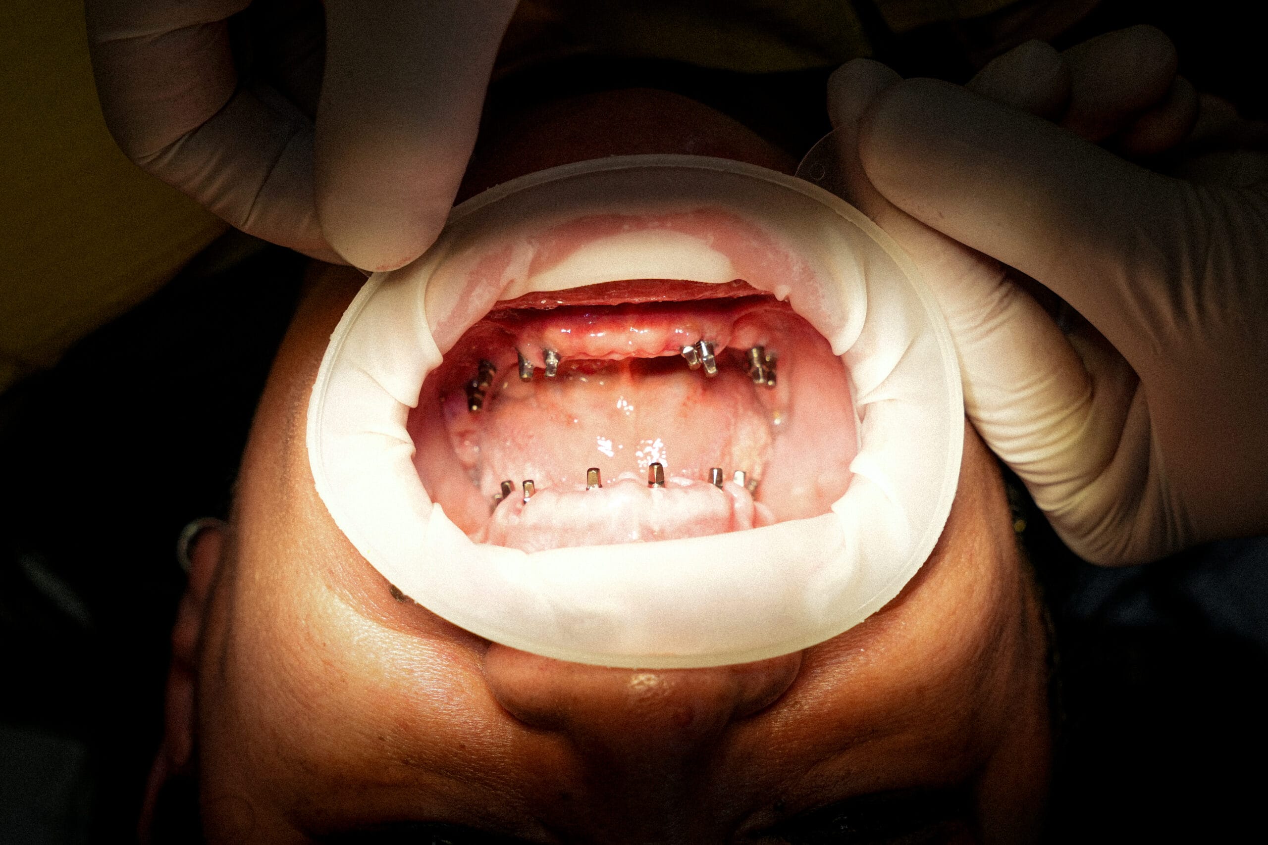 Caso 2, implantes estratégicos colocados en ambas arcadas