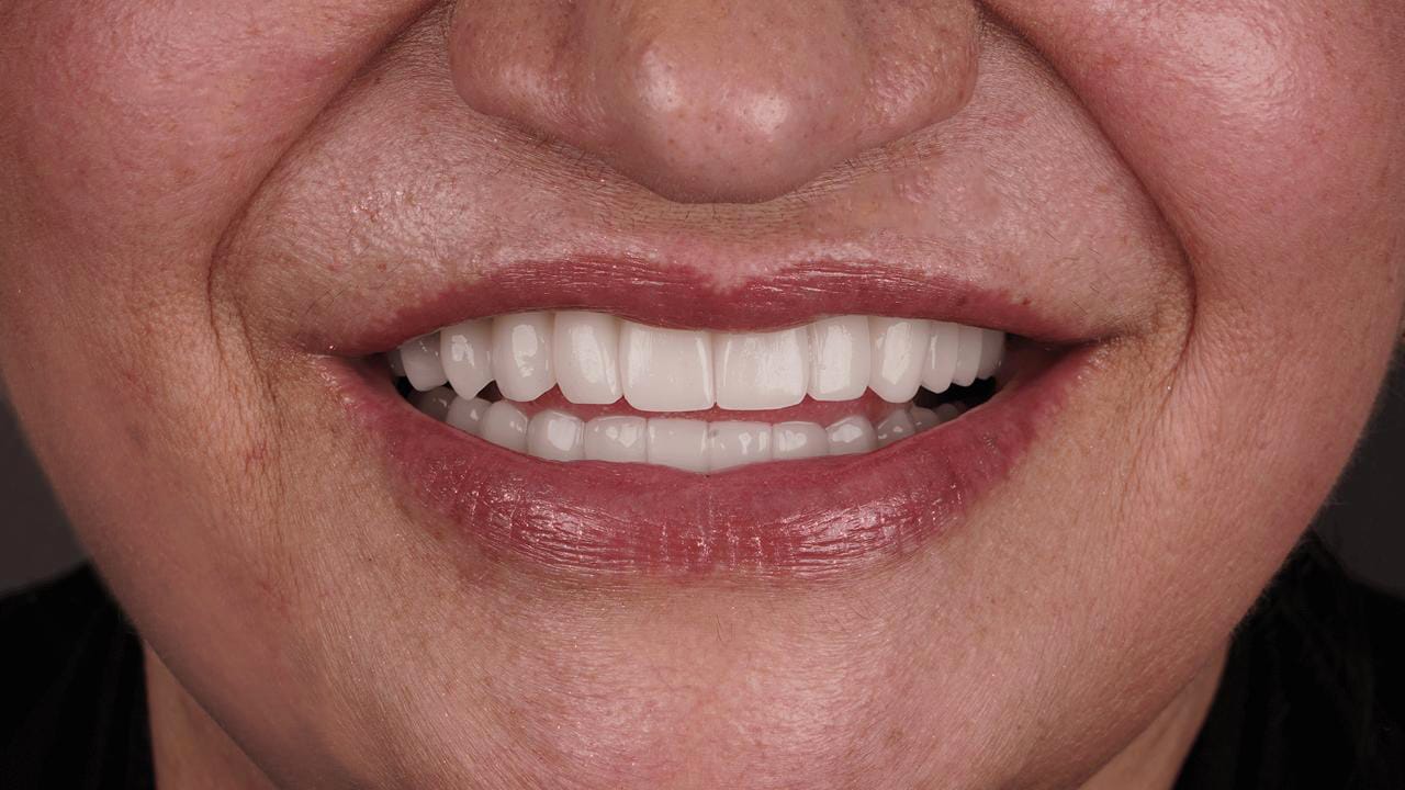 Caso 1, detalle de la sonrisa con la prótesis inicial de PMMA