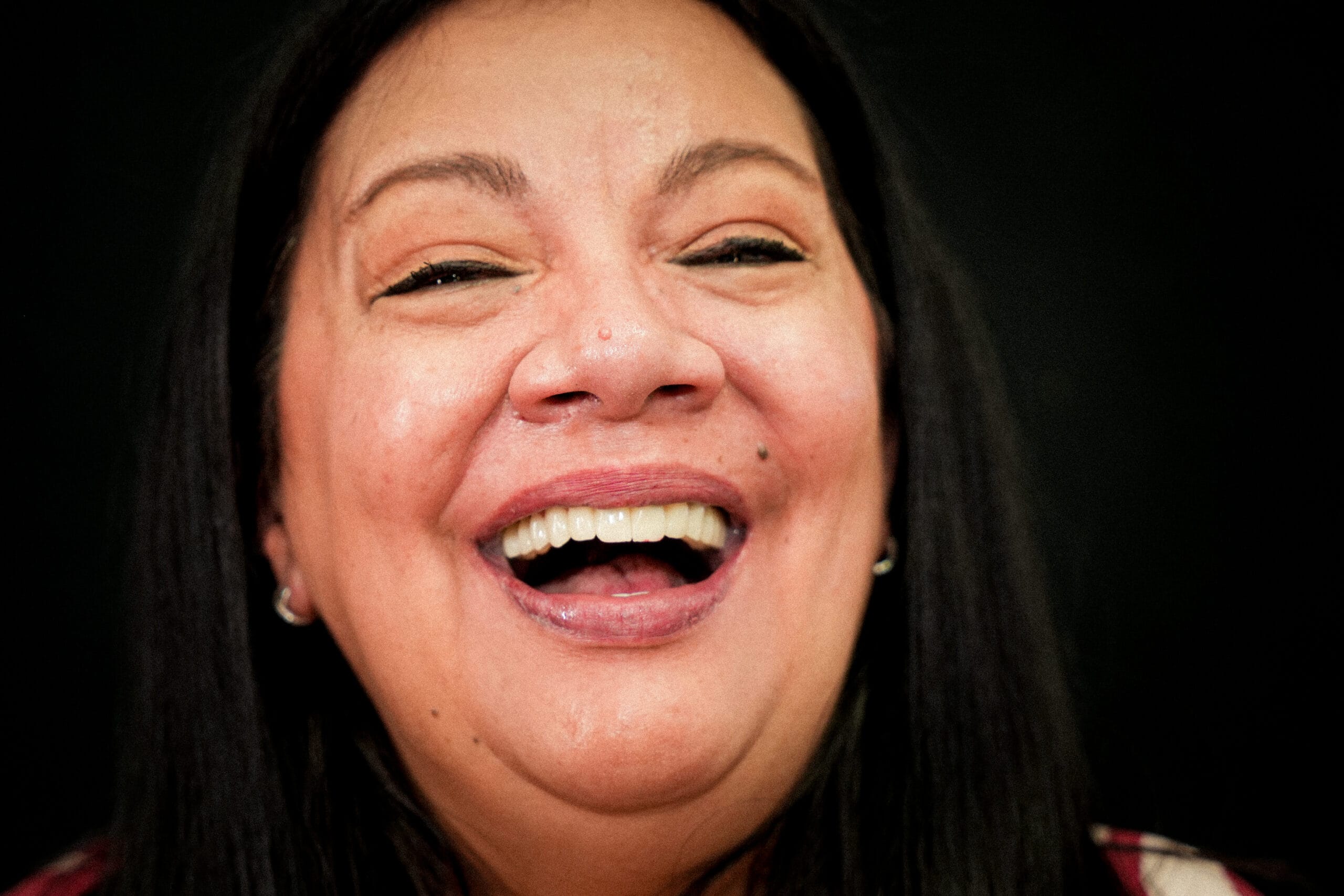 Caso 2, acercamiento de la sonrisa con la prótesis inicial de PMMA