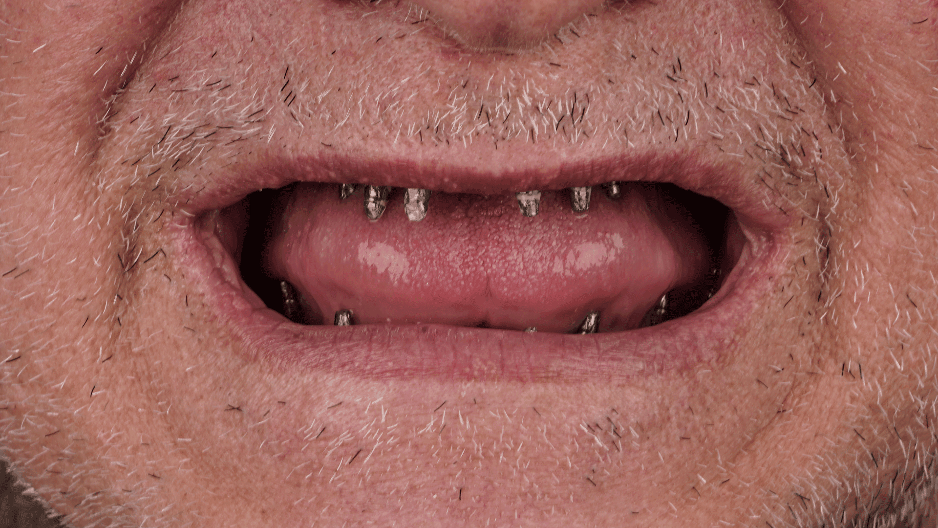 Implantes en ambas arcadas antes de la prótesis definitiva en caso bimaxilar de implantes estratégicos corticobasales