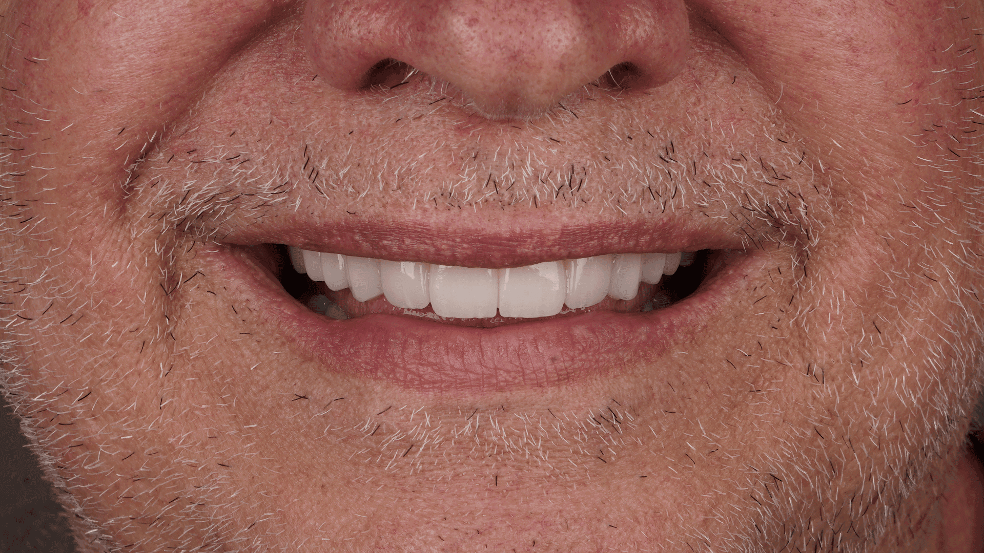 Detalle de la sonrisa con zirconio definitivo en caso bimaxilar de implantes estratégicos corticobasales