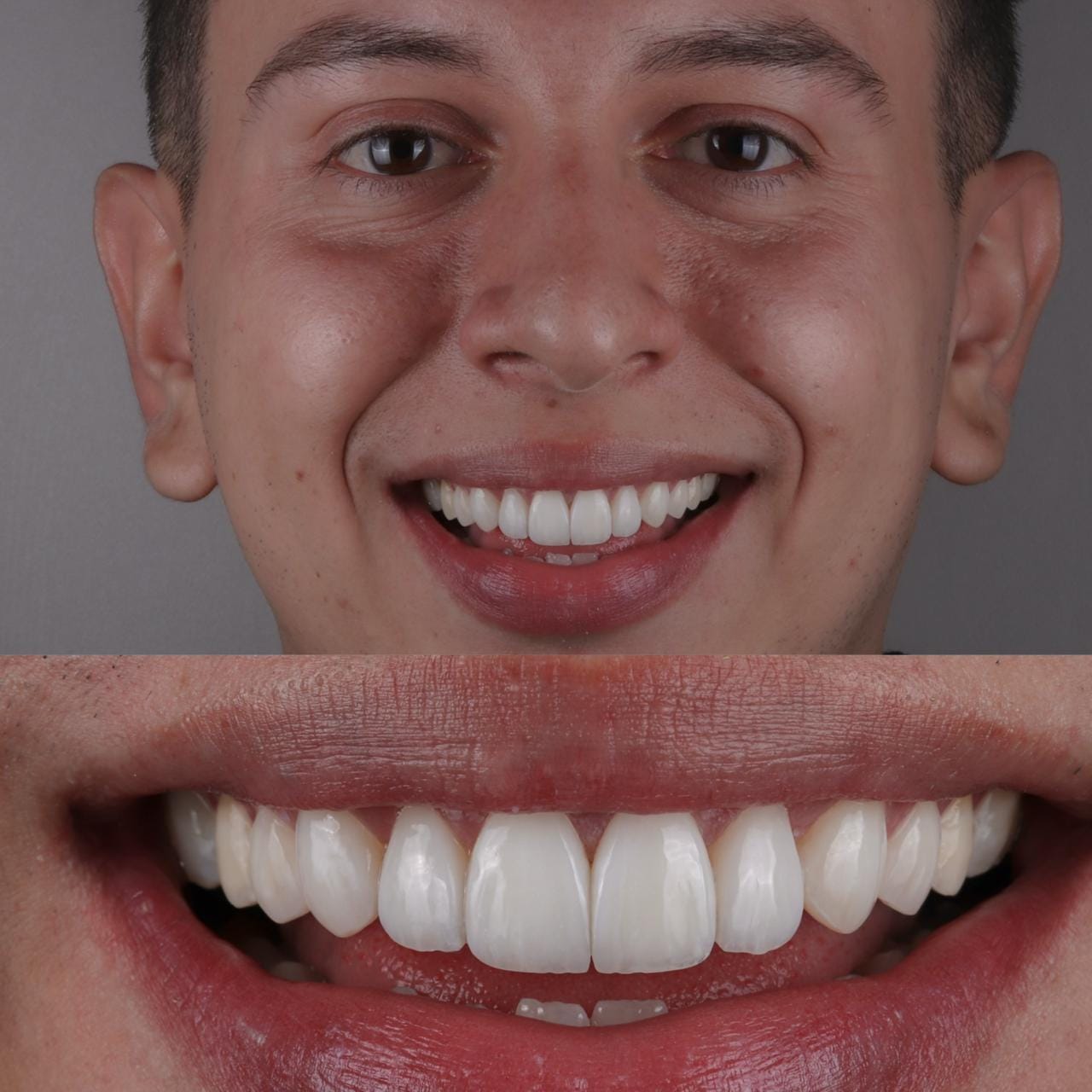 Antes y después de un caso de diseño de sonrisa
