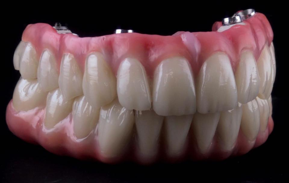 Vista de prótesis fijas sobre implantes All-on-4